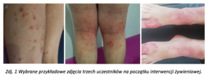 Interwencja żywieniowa Biomarine-stan skóry przed leczeniem