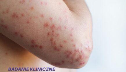 Badanie kliniczne dla pacjentów z wypryskiem pieniążkowatym