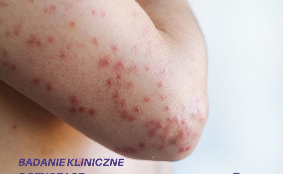 Badanie kliniczne dla pacjentów z wypryskiem pieniążkowatym
