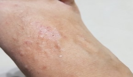 Pacjenci oczekują dostępu do leczenia biologicznego